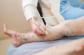 Modern Approaches to Varicose Vein Treatment