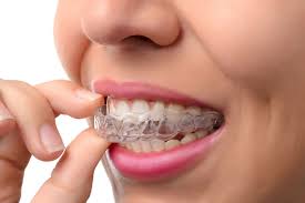 Why Orthodontists Recommend Invisalign Aligners for Adults in Surrey